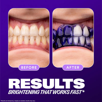 HiSmile V34 Teeth Whitening – هاي سمايل لتبييض الأسنان